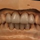 Maxillary and Mandibular Incisors