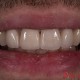 Maxillary Incisors